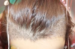 -大麦微针植发全国连锁