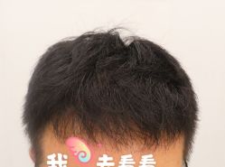 -大麦微针植发全国连锁