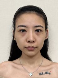 体验前-四川米兰柏羽医学美容医院