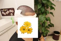 -大麦微针植发丨全国连锁