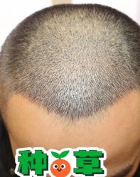 -大麦微针植发丨全国连锁