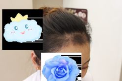 -大麦微针植发丨全国连锁