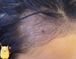 -大麦微针植发丨全国连锁