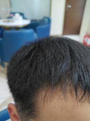 -碧莲盛·不剃发植发