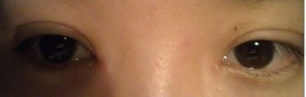 拆线第四天-上海华安整形外科门诊部