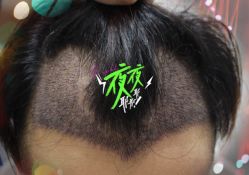 -大麦微针植发全国连锁