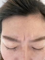 体验前-海涛医疗美容·面部抗衰·注射美鼻