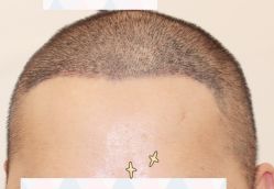 -大麦微针植发全国连锁