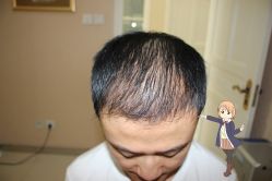 -大麦微针植发丨全国连锁