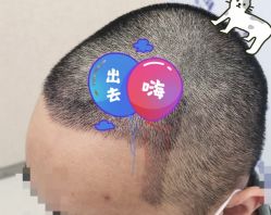 -大麦微针植发全国连锁