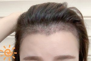 -大麦微针植发丨全国连锁