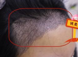 -大麦微针植发全国连锁