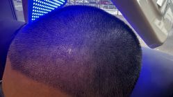 -碧莲盛·不剃发植发