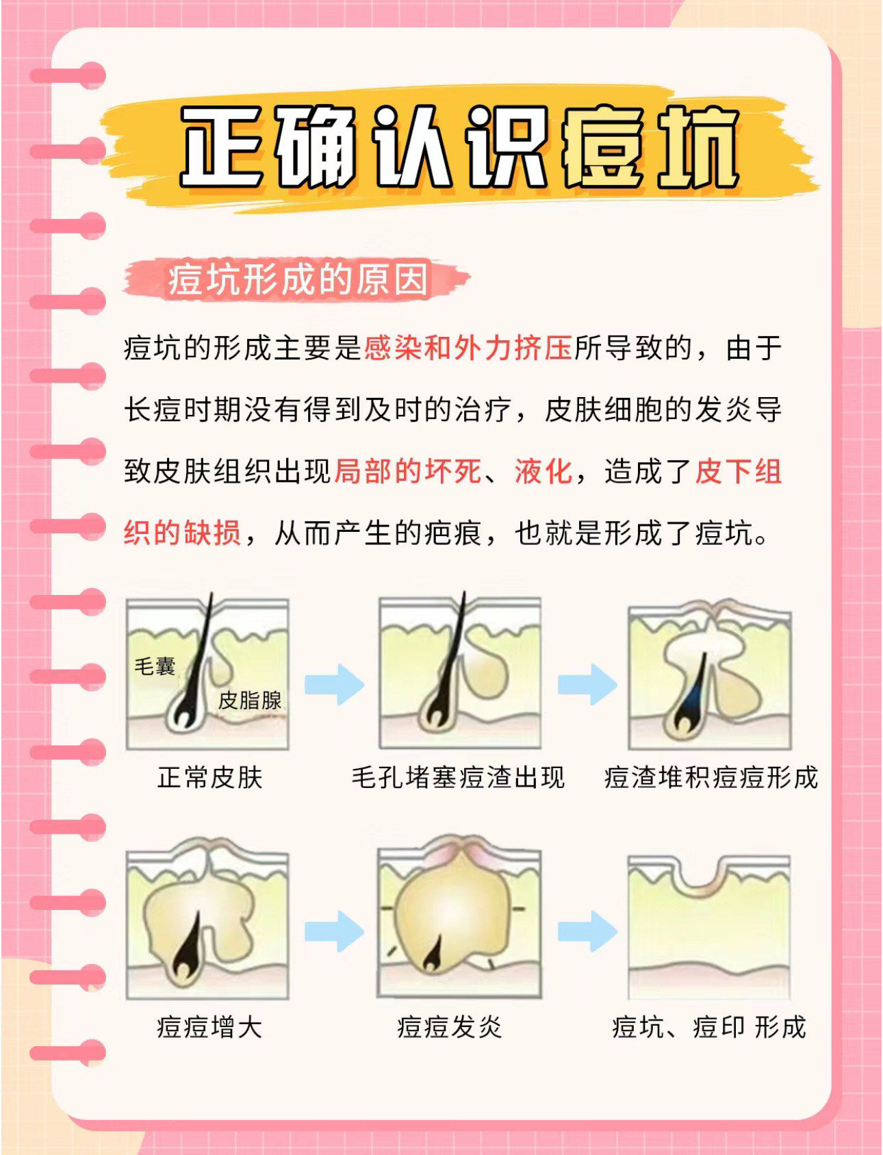 痘坑形成原因
#痘坑痘印 #专业祛痘