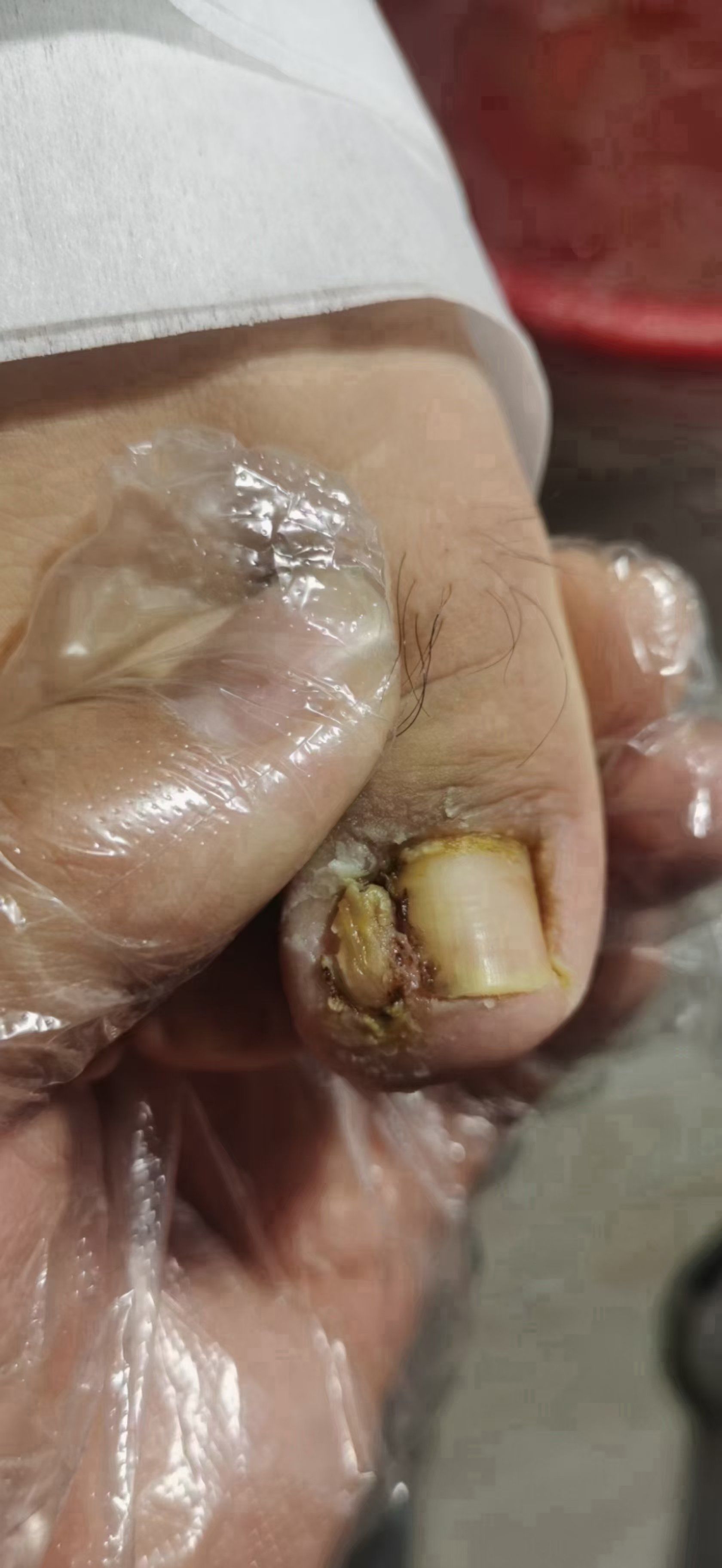 甲沟炎及甲下脓肿的危害