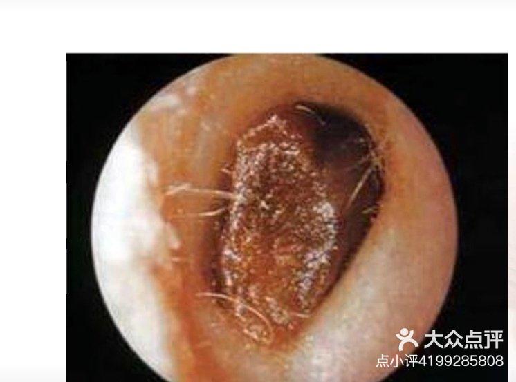 耵聍是什么样子的图片图片