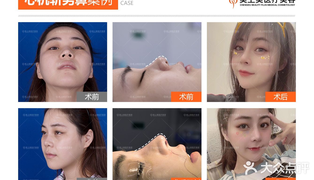 为什么选肋软骨隆鼻