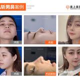 为什么选肋软骨隆鼻