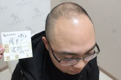 点击看大图 -大麦微针植发丨全国连锁