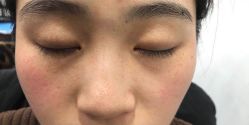 -美丽人生祛斑扁平疣汗管瘤中心