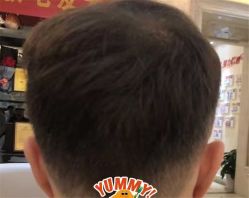 -大麦微针植发全国连锁
