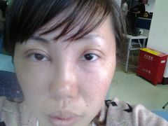 第三天，依然猪头，还有眼袋-上海华安整形外科门诊部