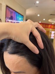 -大麦微针植发全国连锁