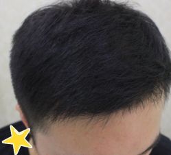 -大麦微针植发丨全国连锁