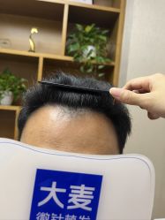 -大麦微针植发全国连锁