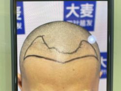 体验前-大麦微针植发丨全国连锁