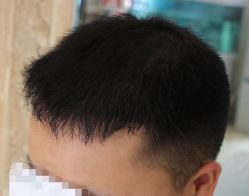 -大麦微针植发全国连锁