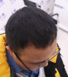 点击看大图 体验后-大麦微针植发全国连锁