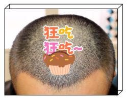 -大麦微针植发全国连锁