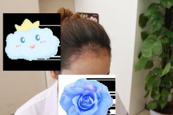 -大麦微针植发丨全国连锁
