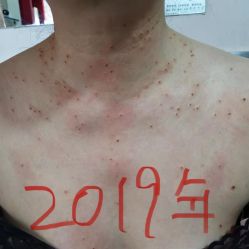 体验前-北京美痣堂古方祛痣斑疣瘊