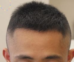 -大麦微针植发丨全国连锁