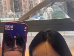 -碧莲盛·不剃发植发