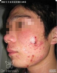 -韩医生专业祛痘连锁机构