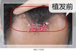 -大麦微针植发全国连锁