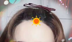 -大麦微针植发全国连锁