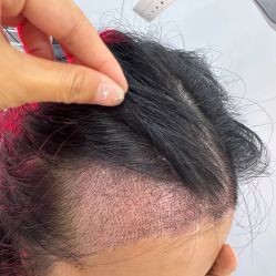 -大麦微针植发全国连锁