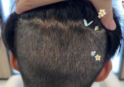 -大麦微针植发全国连锁