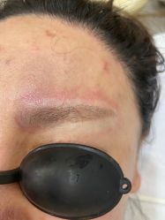 体验后-郡艺医疗美容·微整·眼鼻吸脂