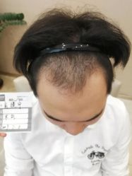 -大麦微针植发丨全国连锁