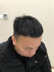 -大麦微针植发丨全国连锁