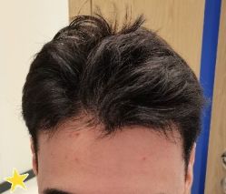 -大麦微针植发丨全国连锁