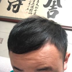 -大麦微针植发全国连锁