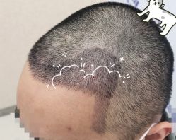 -大麦微针植发全国连锁