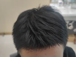 点击看大图 -碧莲盛·不剃发植发