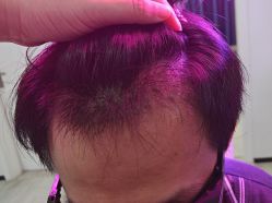 体验后-雍禾植发全国连锁